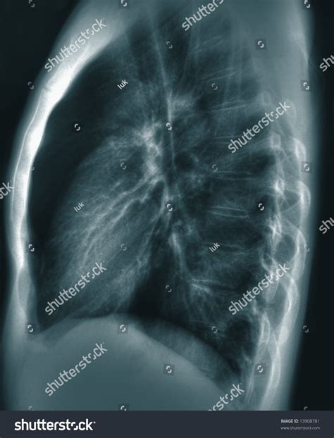 Chest X Ray Side View Stock Photo 13908781 Shutterstock