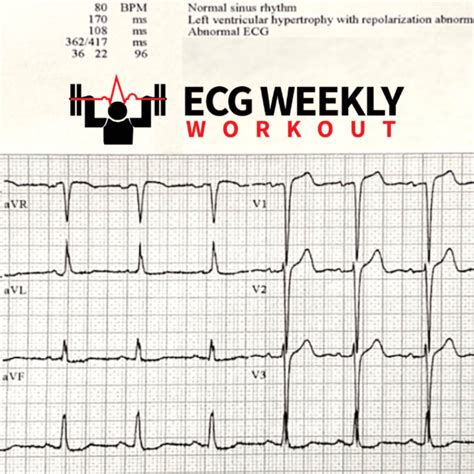 LVH with strain pattern – ECG Weekly