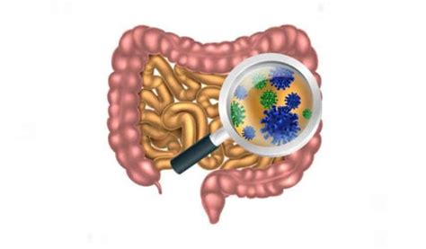 Sobrecrecimiento bacteriano SIBO1 Guía completa