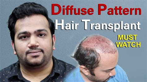 Hair Transplant 2 Sittings In Diffuse Pattern Baldness 4 Years Results By Dr Suneet Youtube