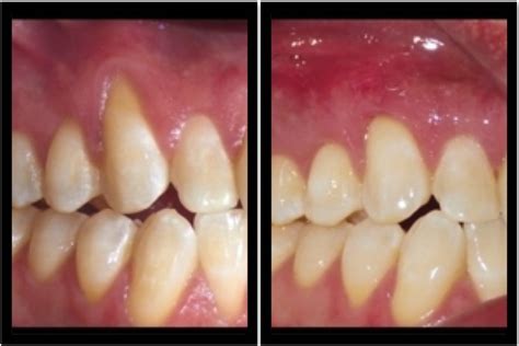 Receding Gum-Line: Learn About the Pinhole Surgical Technique