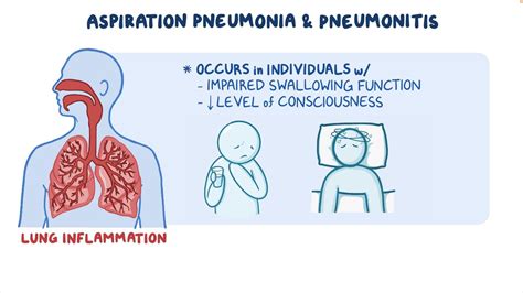 Aspiration pneumonia and pneumonitis: Clinical sciences - Osmosis Video Library