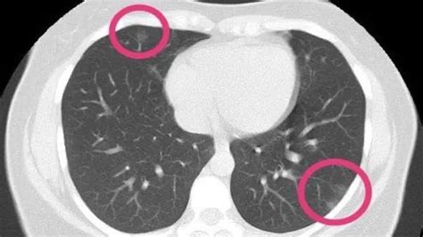 CT scan finds coronavirus pneumonia in lung of woman who had no symptoms : r/Coronavirus