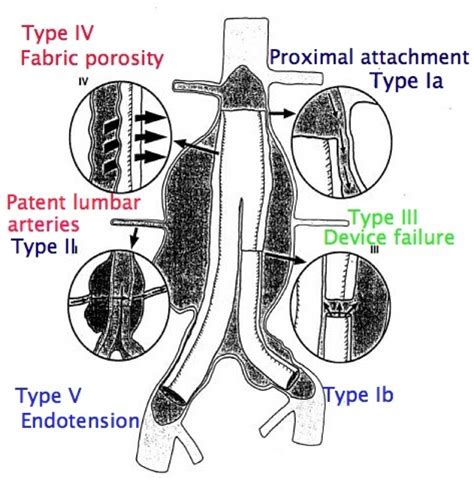 Endoleaks Luke S Radiology Blog