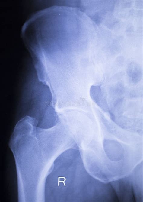 Hip Joint Surgical Implant Xray Scan Stock Image - Image of injured ...