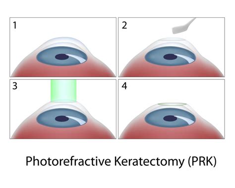 Lasik Vs Lasek Vs Prk Laser Eye Surgery Hub