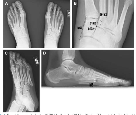 Pdf Imaging Of Lisfranc Injury And Midfoot Sprain Semantic Scholar