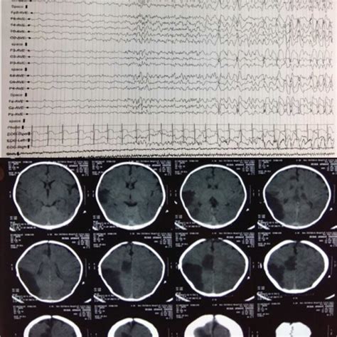 Eeg And Non Contrast Ct Brain Of A Months Old Girl Eeg Showed Left