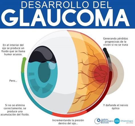 El Glaucoma La Enfermedad Silenciosa Ideal