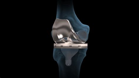 Knee Arthritis: Total Knee Replacement Animation : OrthoPedia Patient