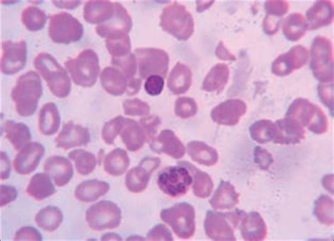 Pancytopenia A Clinico Hematological Study Journal Of Laboratory