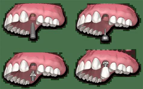 Cuáles Son Las Ventajas De Los Implantes Dentales Cirugía Estética