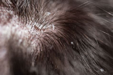 Lice vs. Dandruff: How to Tell the Difference Between Them