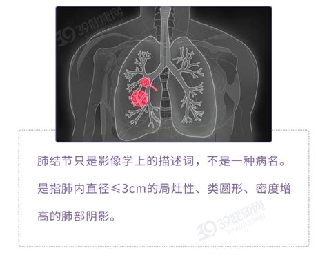 体检发现肺结节怎么办？这2种情况或是癌症前兆凤凰网