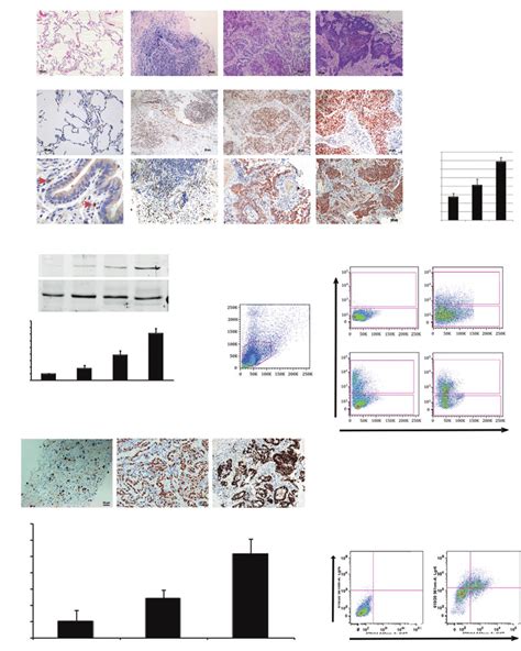 Increased Lgr6 þ Cells During Human Lung Adenocarcinoma Progression A