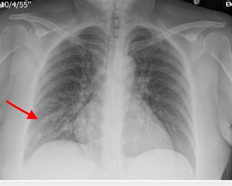 Infiltrate Pneumonia