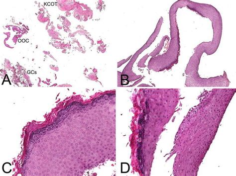 Low Magnification Photomicrograph Revealing A Fragmented Cystic Lining