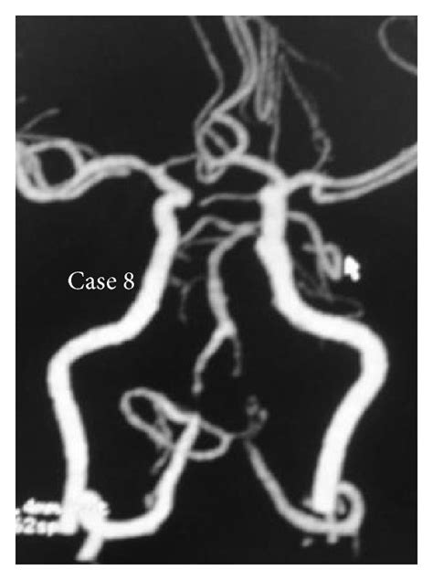 A 61 Year Old Man Case 4 With Bilateral Intracranial Vertebral Artery