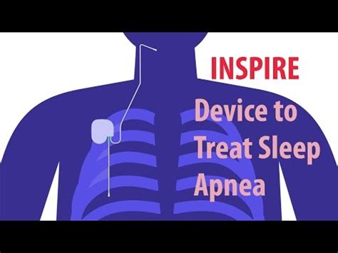 INSPIRE Device to Treat Sleep Apnea Video | Fauquier ENT Blog