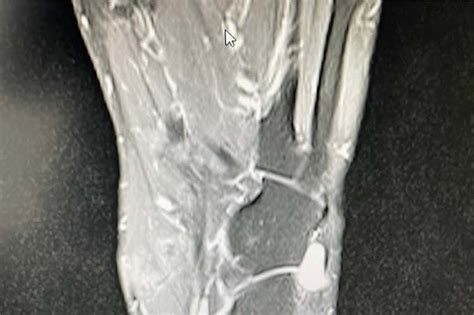 T2 Axial Mri Image Of The Soft Tissue Lesion Over The Lateral Foot In Download Scientific