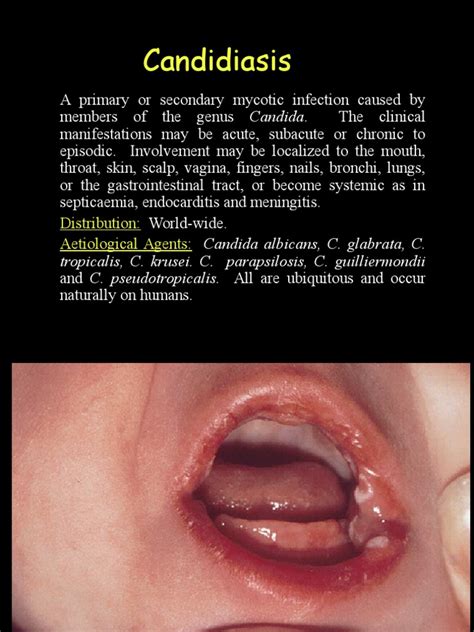 An Overview of Candidiasis: Causes, Symptoms, and Fungal Agents ...