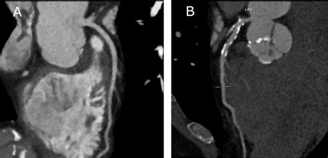 Evaluation Of Coronary Artery Disease With Cardiac Computed Tomography