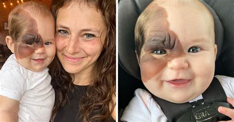 Little Winry Was Born With A Rare Birthmark And Her Mom Shows How