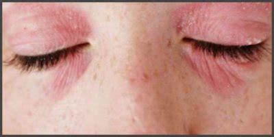 Shingles pictures eye | Shingles Expert