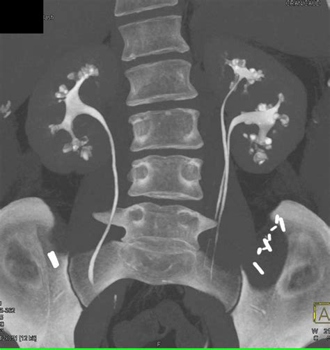 Medullary Sponge Kidney Kidney Case Studies Ctisus Ct Scanning