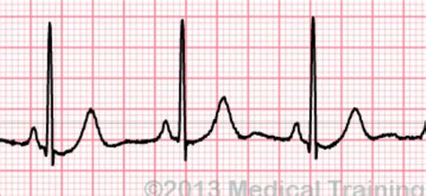 Arrhythmia Identification Flashcards Quizlet