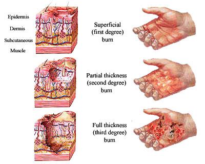 Symptoms And Treatments And Nursing Care For Heat Stroke Burns