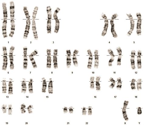 The Sex Chromosomes Revealed That The Patient Was 46 Xy Download Scientific Diagram