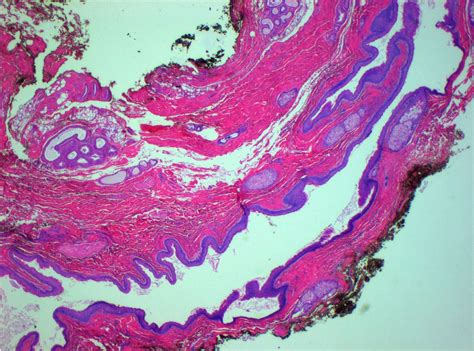 Paramedian Chest Wall Dermoid Cyst Bmj Case Reports