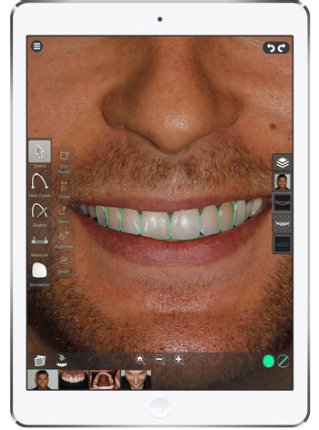 Dental smile design software - regstoun