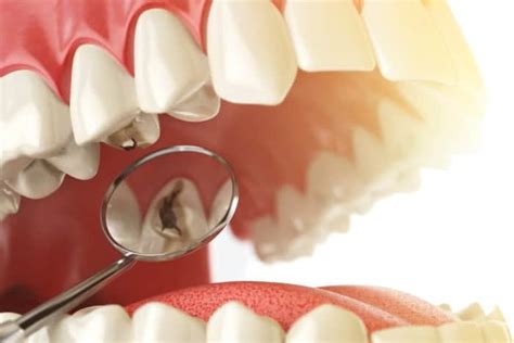 Good Brushing Doesn’t Always Eliminate All Cavities Learn Why