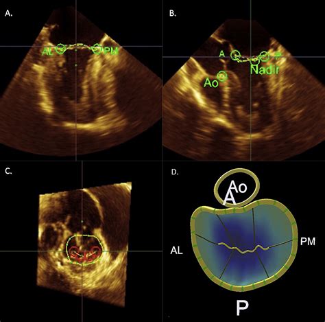 The Value Of Three Dimensional Echocardiography Derived Mitral Valve