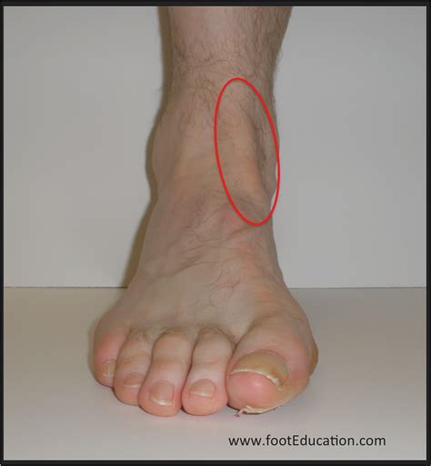 Anterior Tibial Tendonitis Footeducation