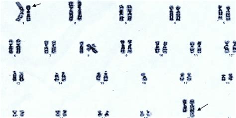 Karyotype shows a balanced reciprocal translocation between the short ...