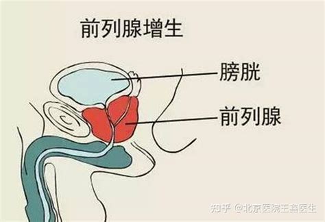 5分钟帮你解决前列腺增生，经尿道前列腺水蒸气消融术！ 知乎