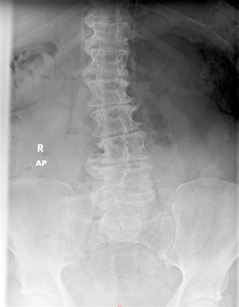 I collect osteophytes. I don’t show my collection to just anyone. : r ...