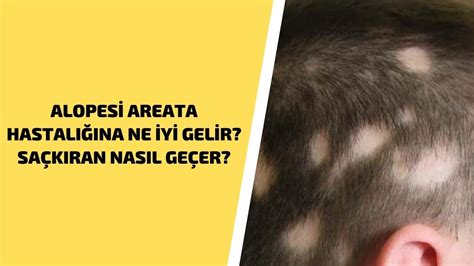 Alopesi Areata Hastalığına Ne İyi Gelir Saçkıran Nasıl Geçer YouTube