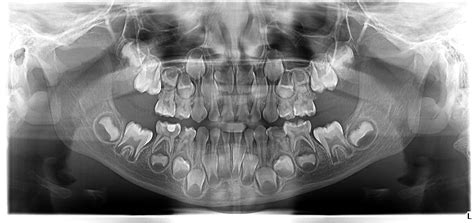 Blog Radiologie Articole Radiografie Dentara Imagistica Cbct Cluj