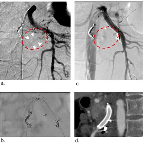 Retrogradely insertion 6.0 Fogarty balloon catheter through the ...