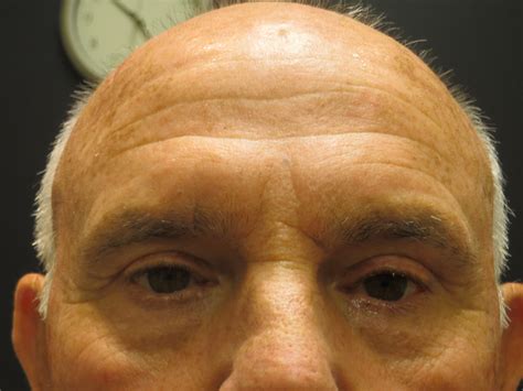 Eyelid Malpositions Ptosis Alicia Carroll Md Oprsc