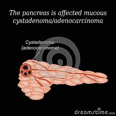 Pancreas Mucous Cystadenoma Adenocarcinoma Vector Illustration On A