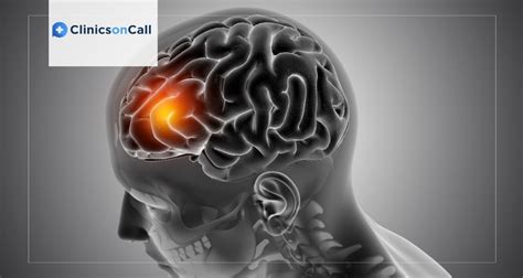 Medulloblastoma Treatment Methods in Foreign Clinics - Clinics on Call