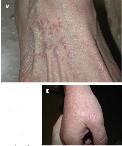 Lichen Planus Types