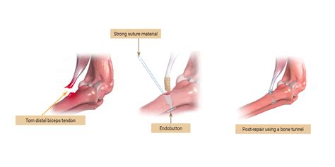 Distal Biceps Tendonitis