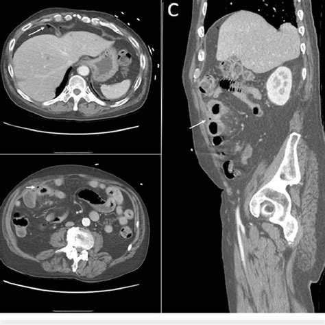 Ct Of The Abdomen And Pelvis With Iv Contrast A Axial View Showing