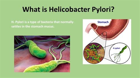 Helicobacter Pylori Archives Worthview